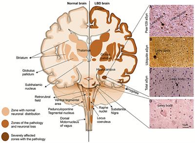 Alpha-Synuclein Post-translational Modifications: Implications for Pathogenesis of Lewy Body Disorders
